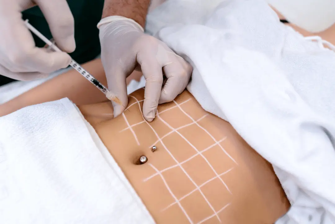 FAT LIPOLYSIS